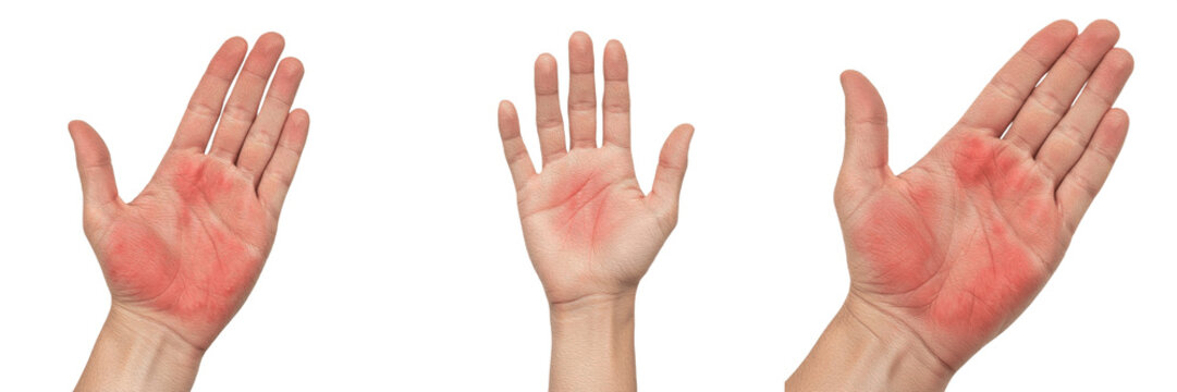 Close-up of human palms with red skin rash, Palmar Erythema symptoms or allergic reaction on hands isolated on white background