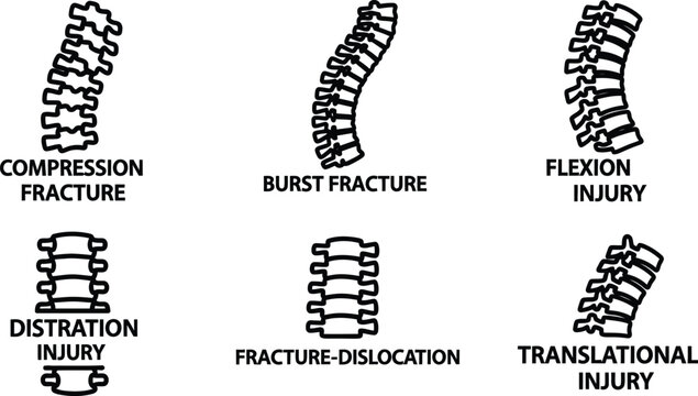 Spinal injuries and fractures illustrations including compression burst flexion distraction fracturedislocation translational
