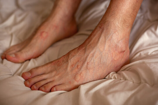 Male feet skin allergic reaction to fever. Urticaria vasculitis disease causes itchy wheals. Swollen varicose veins. Angioedema