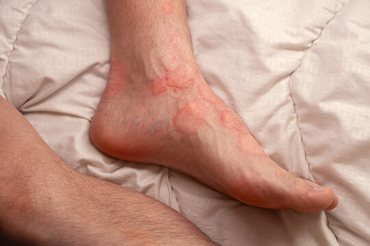 Close up photo of male foot with brighr red spots swollen skin. Feet skin allergic reaction to fever. Urticaria vasculitis disease causes itchy wheals. Angioedema on feet.