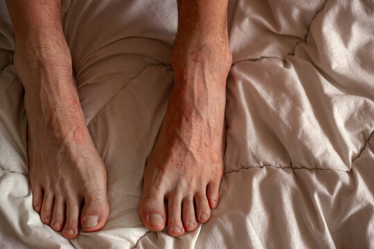 Top view of male feet with red swollen skin rash. Feet skin allergic reaction to fever. Urticaria vasculitis disease causes itchy wheals. 