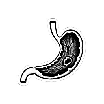 Medical illustration of human stomach showing gastric folds, pyloric sphincter, and internal musculature, rendered in black and white with stippling texture.