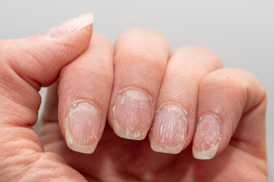 Close-up of damaged natural nails. A natural hand with problematic cuticles and broken nails. Emotional stress. Age-related skin changes. Hand care.