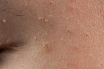Fototapeta premium Pimple on epidermis with pustule and bumps. Acne with comedone and inflamed pores. Skincare for pimple and inflammation. Macro detail of acne with texture.