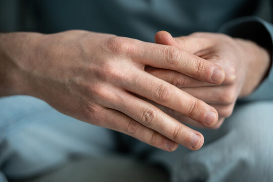 Man showing hands with dry peeling skin over knuckles and fingers, common symptoms of dehydration, dangerous condition where body loses more fluids than takes in, preventing normal health function.