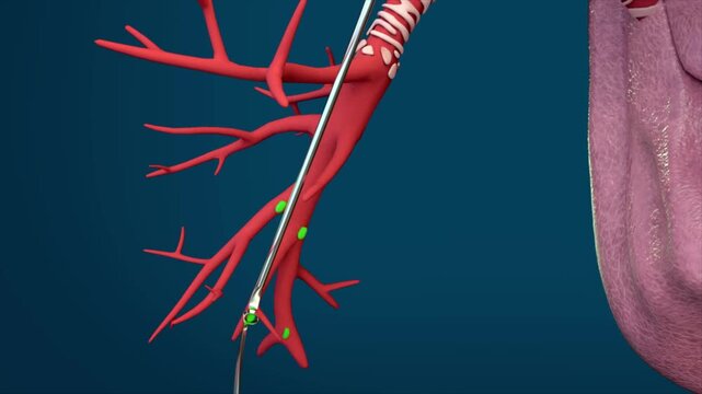 Lung tumor resection surgery, removal of lymph nodes near the tumor to inhibit tumor cell proliferation. Lung surgery. Surgical procedure, 3D animation.