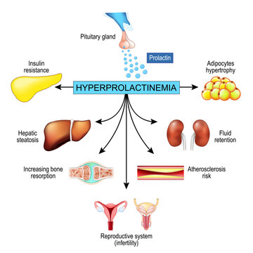 Effects of hyperprolactinemia. Pituitary disorder