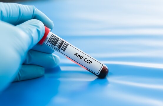 Blood sample tube for anti-CCP test analysis.