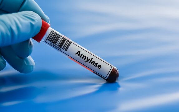 Blood sample tube for amaylase test analysis.