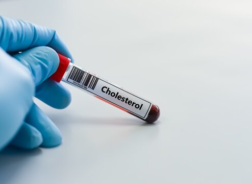 Blood sample tube for cholesterol test analysis.
