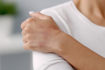 Naklejka premium Close-up of a woman's hand showing a bruise on her wrist and forearm, wearing a white shirt.