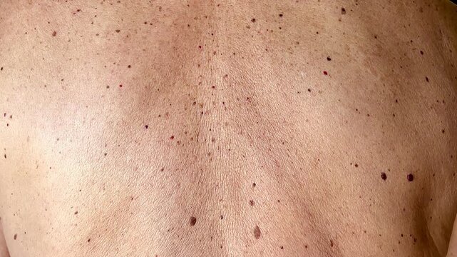 Many  birthmark and moles on skin of elderly man  video horizontal