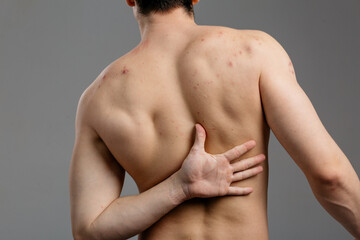 Obraz premium The young man's back is covered with pimples and signs of inflammation. The concept: men's health and untimely visits to the dermatologist, skin problems due to blood diseases and malnutrition