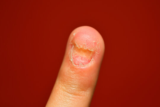 Damaged nail showing health problem. Toenail fungus. A podologist examines toenails affected by a fungal infection. Onycholysis of nails. Toenail fungal infection.