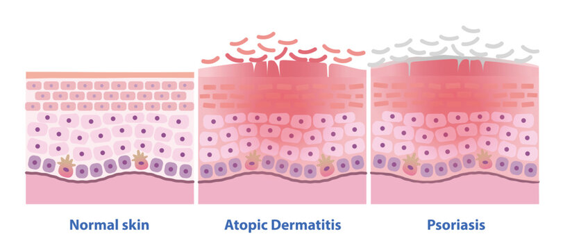 Comparison of normal skin, Atopic Dermatitis and Psoriasis vector illustration. Cross section of Eczema, itchy, red, inflamed, leading to dry, scaly. Psoriasis plaques are thick, silvery scales.