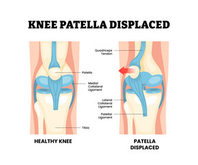 Fototapeta premium Knee patella displaced joint knee disease. Labeled ligament, patella. Patellar dislocation with ligament strain and joint instability Synovial joint anatomy. Frontal and side view Vector illustration.