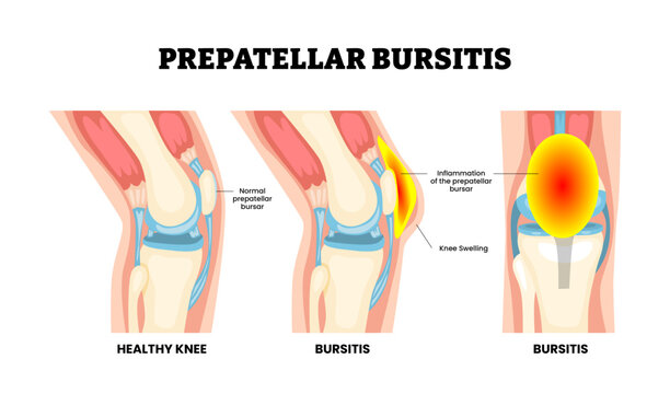 Prepatellar bursitis joint knee disease. Normal and inflamed prepatellar bursae, swollen knee swelling. Fluid accumulation, patellar tendon, subcutaneous tissue. Frontal side view Vector illustration.