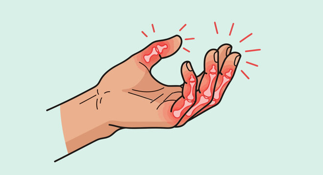 Inflamed Hand Joints: Arthritis Pain, Swelling, and Inflammation in Fingers and Knuckles