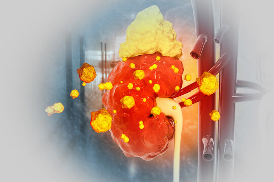 Kidney stone disease. Renal stones. Medical solidarity concept. Human body organ anatomy. 3d illustration