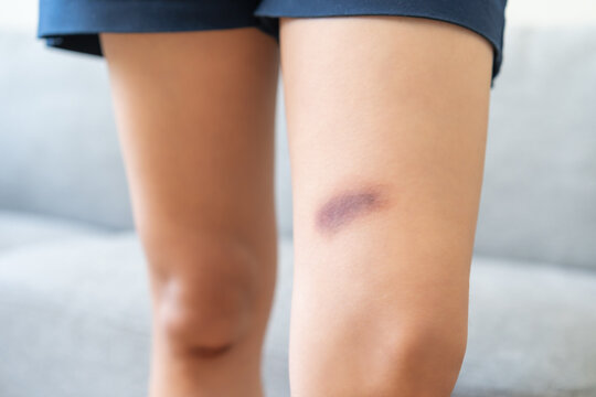 Damage of stain bruise wound on arm, contusion asian young woman, girl an accident fell down stairs, show on her leg in healing injury by massage hematoma blood. Extravasation blue, purple on skin.