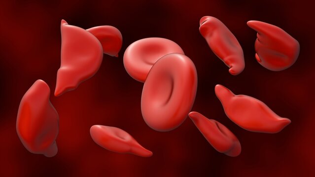 3D Medical Visualization of Schistocytes: Fragmented and Normal-Shaped Red Blood Cells Illustrating Mechanical Shearing and Microangiopathic Hemolytic Anemia.