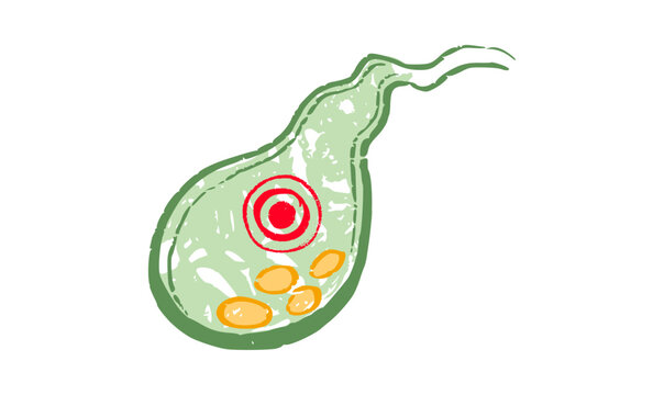 Human Gallbladder Disease