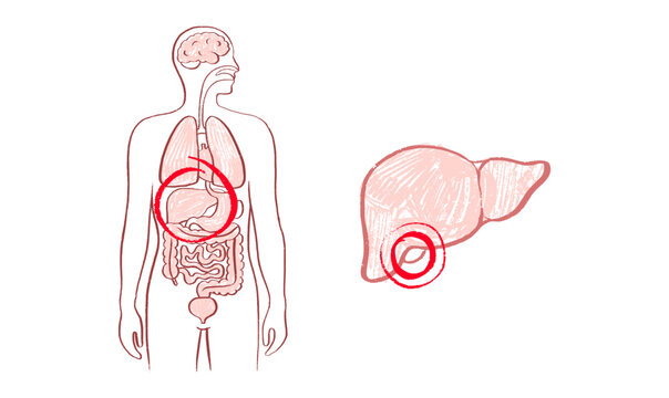 Human Gallbladder Disease