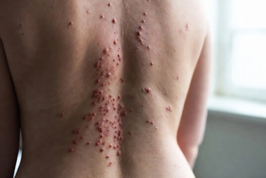 A person&rsquo;s back with numerous pustules and bumps, likely suffering from a skin infection.