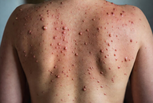 A person&rsquo;s back with a widespread rash of pustules, likely varicelliform pustulosis.