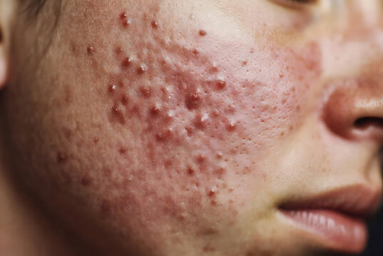 A close-up of a person&rsquo;s face with severe acne.