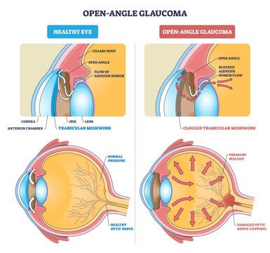 Open-angle glaucoma overview contrasts healthy vs blocked outflow, trabecular meshwork, aqueous humor flow, and optic nerve show pressure buildup concept, transparent background.