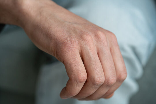 Male hand affected by skin dryness on back of hand and over knuckles area, cracked flaky skin reaction shows signs of body dehydration. Man hand with dry itchy skin requires treatment and moisturizing