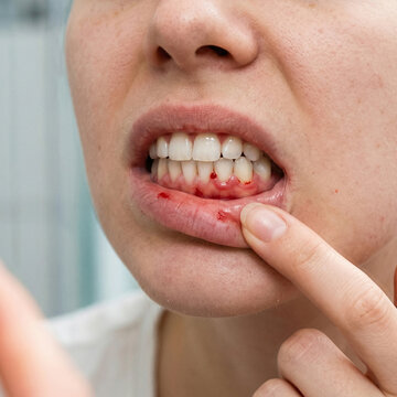 Close-up of a young woman's mouth and lips as she examines red bleeding gums, dental health concept focusing on gingivitis, periodontitis, and oral hygiene issues