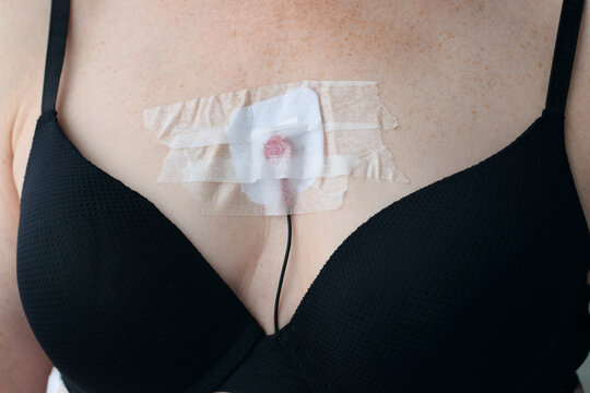 Closeup woman chest in black bra with holter monitor electrode attached to skin in center. Medical device detail highlighting cardiac monitoring, diagnostics, and healthcare equipment.