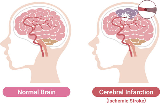 Ischemic stroke brain infarction comparison with normal brain medical illustration(English Labels)