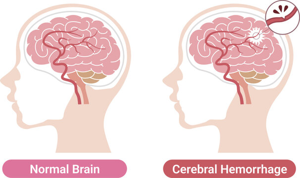 Cerebral hemorrhage comparison with normal brain medical illustration(English Labels)	
