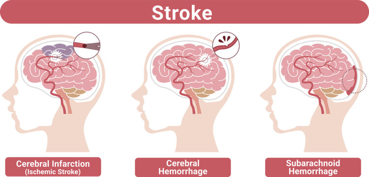 Stroke types brain infarction cerebral hemorrhage subarachnoid hemorrhage medical illustration(English Labels)