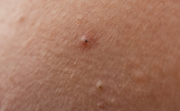 Pimple on pores with whiteheads and bumps. Acne with inflammation and papules. Skincare concept for acne and epidermis. Detail of pimple with blemish and irritation.