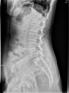 Lateral View of Lumbar Spine X-ray Showing Spondylolisthesis and Vertebral Slippage.