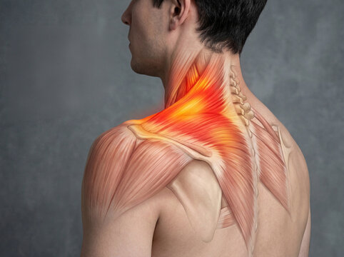 Detailed anatomical view of upper back muscles showing myofascial tension and inflammation