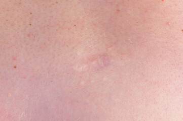 Fototapeta premium Close up of surgical scar after nevus removal on human skin showing healing and dermatology treatment
