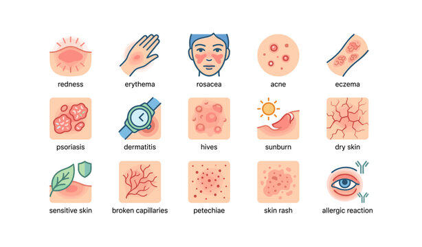 Skin conditions: rosacea, acne, eczema and more illustrated