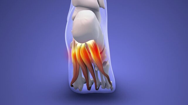 Plantar Fasciitis Causing Heel Pain and Inflammation