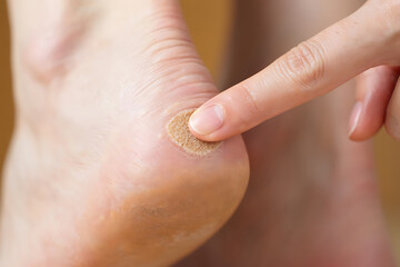 Naklejka premium Close up of a finger touching a callus on a human heel foot skin