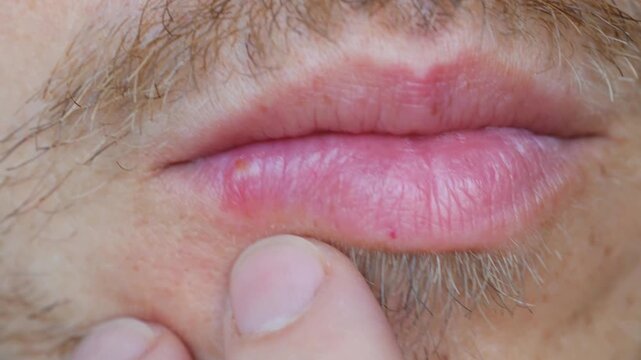 Extreme close up of a man mouth showing the early stages of a cold sore, also known as herpes simplex virus, while he points at the blister with his finger, illustrating the painful infection