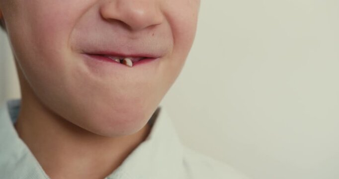 Close-up of a boy face with his first baby tooth wobbling. He plays with his lips and moves the tooth, trying to get rid of it faster. Children dental hygiene.