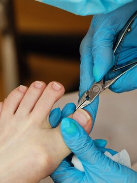 Podiatrist treating fungal nail infection on patient's foot in clinic context.