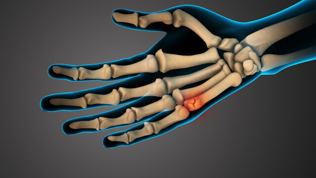 Metacarpal Bone Crack in Human Hand Anatomy