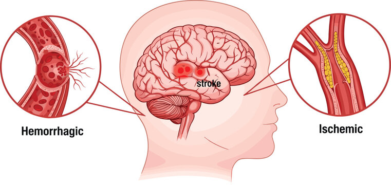 This illustration depicts the human brain and vasculature showcasing both hemorrhagic and ischemic stroke types and their effects high quality professional detailed modern