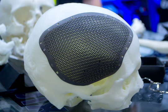 Titanium cranioplates. Prototype of human skull from white plastic with individual patient-specific cranial plate grid made of biocompatible titanium printed on 3D printer. Bioengineering implant